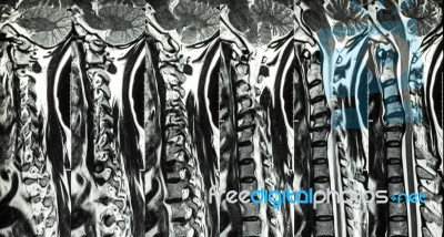 Cervical Spondylosis With Disc Herniation ( Mri Of Cervical Spine : Show Cervical Spondylosis With Disc Herniation Compress Spinal Cord ( Myelopathy ) ) Stock Photo Cervical Spondylosis With Disc Herniation ( Mri Of Cervical Spine : Show Cervical Spondylosis With Disc Herniation Compress Spinal Cord ( Myelopathy ) ) Stock Photo