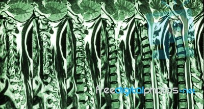 Cervical Spondylosis With Disc Herniation ( Mri Of Cervical Spine : Show Cervical Spondylosis With Disc Herniation Compress Spinal Cord ( Myelopathy ) ) Stock Photo