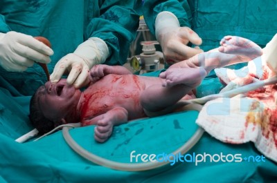 Cesarean Section Stock Photo