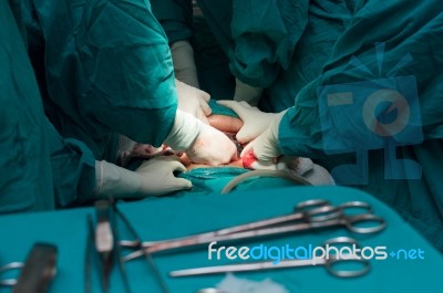 Cesarean Section Stock Photo