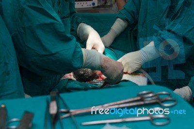 Cesarean Section Stock Photo
