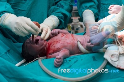 Cesarean Section Stock Photo