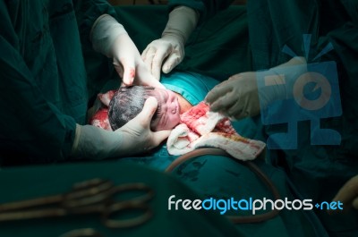 Cesarean Section Stock Photo