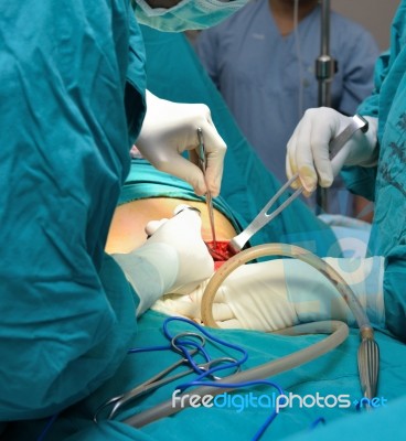 Cesarean Section Stock Photo