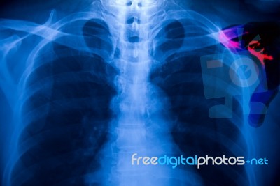 Chest X-ray Stock Photo