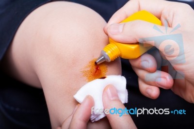 Close Up Wound On Child Leg Stock Photo