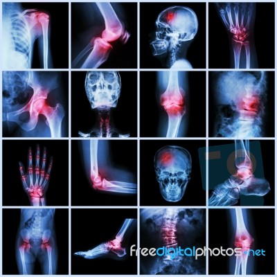 Collection Human Joint And Arthritis And Stroke Stock Photo