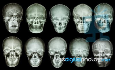 Collection Of Asian Skull (anterior View) (thai People) Stock Photo