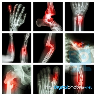 Collection Of Bone Fracture Stock Photo