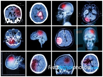 Collection Of Brain Disease ( Ct Scan And Mri Of Brain : Show Cerebral Infarct , Intracerebral Hemorrhage , Brain Tumor , Basal Ganglia Hemorrhage ( Status Post Craniotomy ) ) ( Health Care Concept ) Stock Photo