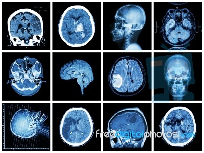 Collection Of Brain Disease ( Ct Scan And Mri Of Brain : Show Cerebral Infarct , Intracerebral Hemorrhage , Brain Tumor , Basal Ganglia Hemorrhage ( Status Post Craniotomy ) ) ( Health Care Concept ) Stock Photo