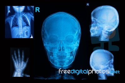 Collection Of Children X-rays Image Stock Photo