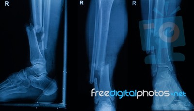 Collection Of Human X-rays  Showing Fracture Of Right Leg ( Fracture Both Bones ) Stock Photo
