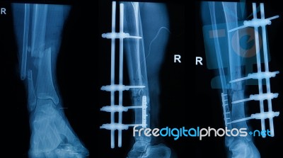 Collection Of Human X-rays  Showing Fracture Of Right Leg , Pre And Post  Operated With External Fixed By Plate And Screw Stock Photo