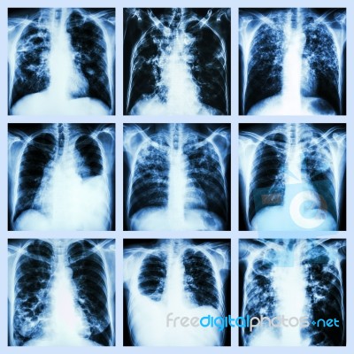 Collection Of Lung Disease (pulmonary Tuberculosis,pleural Effusion,bronchiectasis) Stock Photo