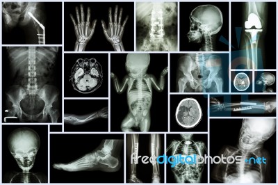 Collection X-ray Multiple Adult And Child's Organ & Orthopedic Surgery & Multiple Disease (stroke , Osteoarthritis Knee , Fracture Bone , Etc) Stock Photo