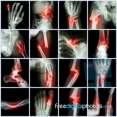 Collection X-ray Multiple Bone Fracture (finger,spine,wrist,hip,leg,clavicle,ankle,elbow,arm,foot) Stock Photo