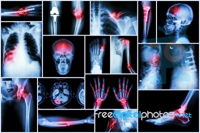 Collection X-ray Multiple Disease (stroke ,fracture ,osteoarthritis ,pneumonia ,tuberculosis ,spondylosis ,spondylolisthesis ,gout ,rheumatoid Arthritis ,brain Tumor ,orthopedic Operation ,etc) Stock Photo