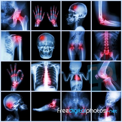 Collection X-ray Multiple Part Of Human And Arthritis,multiple Disease (gout , Rheumatoid,congenital Heart Disease,stroke) Stock Photo