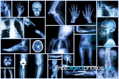 Collection X-ray Multiple Part Of Human & Orthopedic Surgery & Multiple Disease (osteoarthritis Knee,spondylosis,stroke,fracture Bone,pulmonary Tuberculosis, Etc) Stock Photo