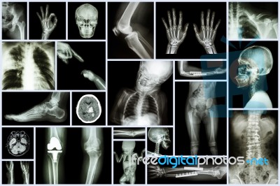 Collection X-ray Multiple Part Of Human & Orthopedic Surgery & Multiple Disease (osteoarthritis Knee,spondylosis,stroke,fracture Bone,pulmonary Tuberculosis, Etc) Stock Photo