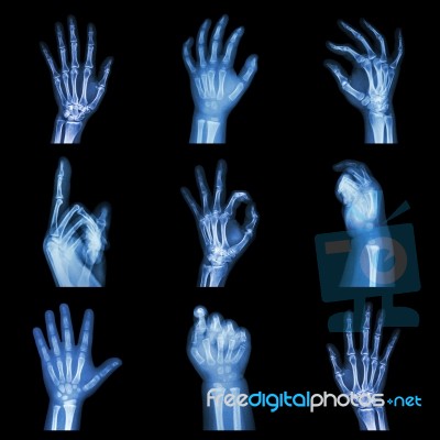 Collection X-ray Of Hands Stock Photo