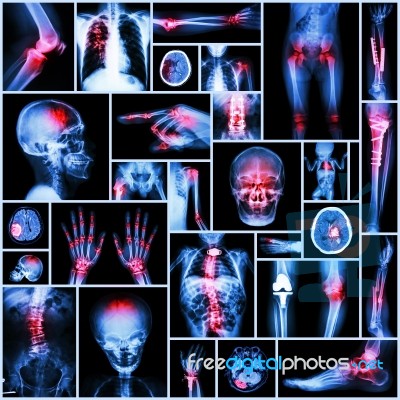 Collection X-ray Part Of Human,orthopedic Operation,multiple Disease (fracture,gout,rheumatoid Arthritis,osteoarthritis Knee,stroke,brain Tumor,scoliosis,tuberculosis, Etc.) Stock Photo