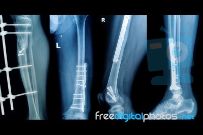 Collection X-rays Image Of  Fracture Lower Extremity Stock Photo