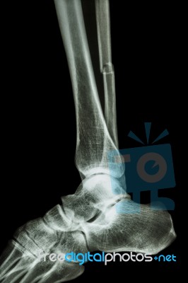 Complete Fracture Shaft Of Fibula (leg's Bone) Stock Photo