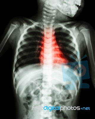 Congenital Heart Disease , Rheumatic Heart Disease ( X-ray Body Of Child And Red Color On Heart Area ) Stock Photo