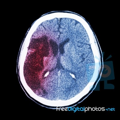 Ct Brain : Show Ischemic Stroke (hypodensity At Right Frontal-pa… Stock Photo