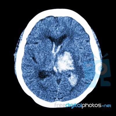 Ct Brain : Show Left Thalamic Hemorrhage (hemorrhagic Stroke) Stock Photo