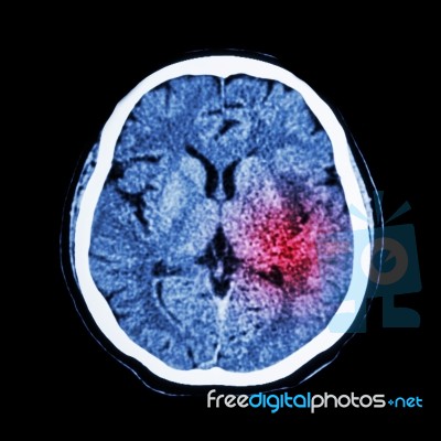 Ct Scan Of Brain Show Ischemic Stroke Or Hemorrhagic Stroke Stock Photo