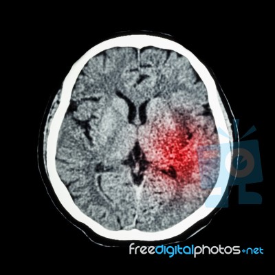 Ct Scan Of Brain Show Ischemic Stroke Or Hemorrhagic Stroke Stock Photo Ct Scan Of Brain Show Ischemic Stroke Or Hemorrhagic Stroke Stock Photo