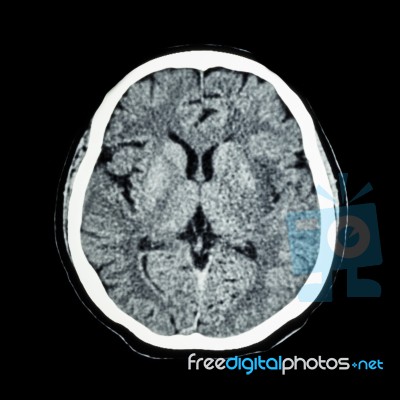 Ct Scan Of Brain : Show Normal Human 's Brain ( Cat Scan ) Stock Photo