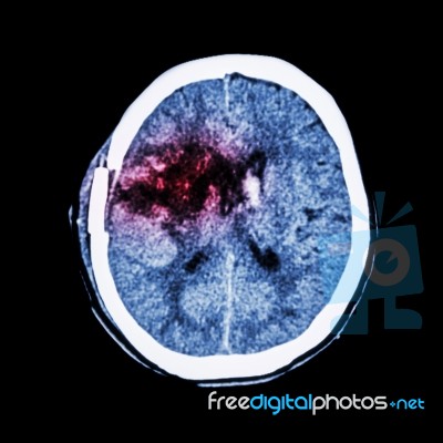 Ct Scan Of Brain : Show Old Right Basal Ganglia Hemorrhage With Brain Edema ( Status Post Craniotomy ) ( Hemorrhagic Stroke ) Stock Photo