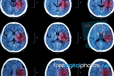 Ct Scan Of Brain With Red Area ( Imaging For Hemorrhagic Stroke Or Ischemic Stroke ( Infarction ) Concept ) Stock Photo