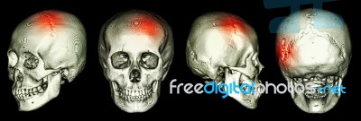 Ct Scan Of Human Skull And 3d With Stroke (cerebrovascular Accident) Stock Photo