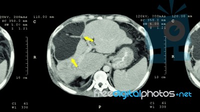 Ct Scan Of Upper Abdomen : Show Abnormal Mass At Liver ( Liver Cancer ) Stock Photo