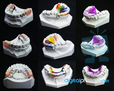 Dental Braces Stock Photo