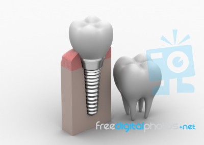 Dental Implantation Stock Image