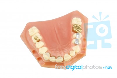Dental Model (with Different Treatments) Stock Photo