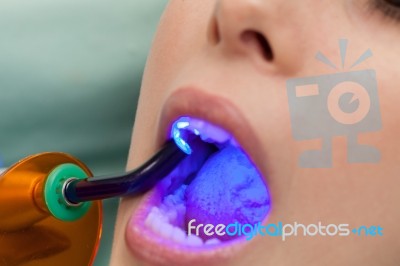 Dental Obturation Stock Photo