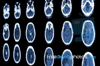 Film Ct Scan Of Brain Show Ischemic Stroke And Hemorrhagic Strok… Stock Photo