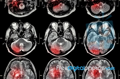 Film Mri ( Magnetic Resonance Imaging ) Of Brain ( Stroke , Brain Tumor , Cerebral Infarction , Intracerebral Hemorrhage )  ( Medical , Health Care , Science Background ) ( Cross Section Of Brain )film Mri ( Magnetic Resonance Imaging ) Of Brain ( Stroke , Stock Photo