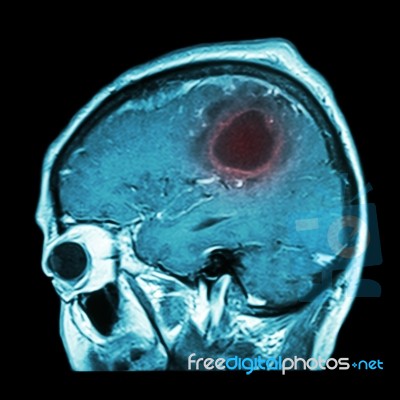 Film Mri Of Brain With Brain Tumor ( Sagittal Plane , Side View , Lateral View ) ( Medical , Health Care , Science Background ) Stock Photo Film Mri Of Brain With Brain Tumor ( Sagittal Plane , Side View , Lateral View ) ( Medical , Health Care , Science Background ) Stock Photo