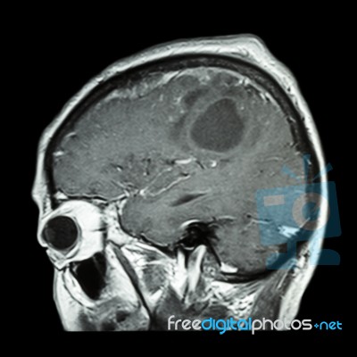 Film Mri Of Brain With Brain Tumor ( Sagittal Plane , Side View , Lateral View ) ( Medical , Health Care , Science Background ) Stock Photo