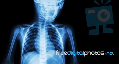 Film X-ray Body Of Child And Blank Area At Right Side ( Medical Background ) Stock Photo