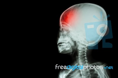 Film X-ray Body Of Child And Headache ( Brain Disease ) ( Isolated ) Stock Photo