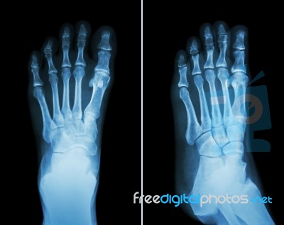 Film X-ray Both Foot ( 2 Position : Front View And Side View ) Stock Photo